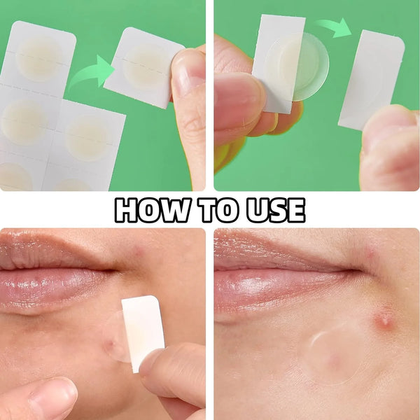 24 capsules/box of acne patches - alcohol free, non irritating, effective in removing acne, suitable for all skin types