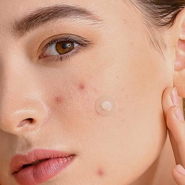 360PCS Skin-Colored Acne Patches - Ultra Thin, Waterproof & Gentle for Day/Night Pimple Coverage